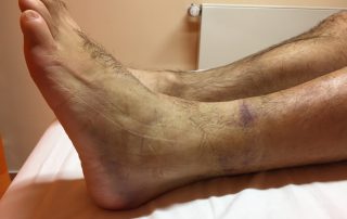 Fuß mit sichtbarer Schwellung und Hämatom