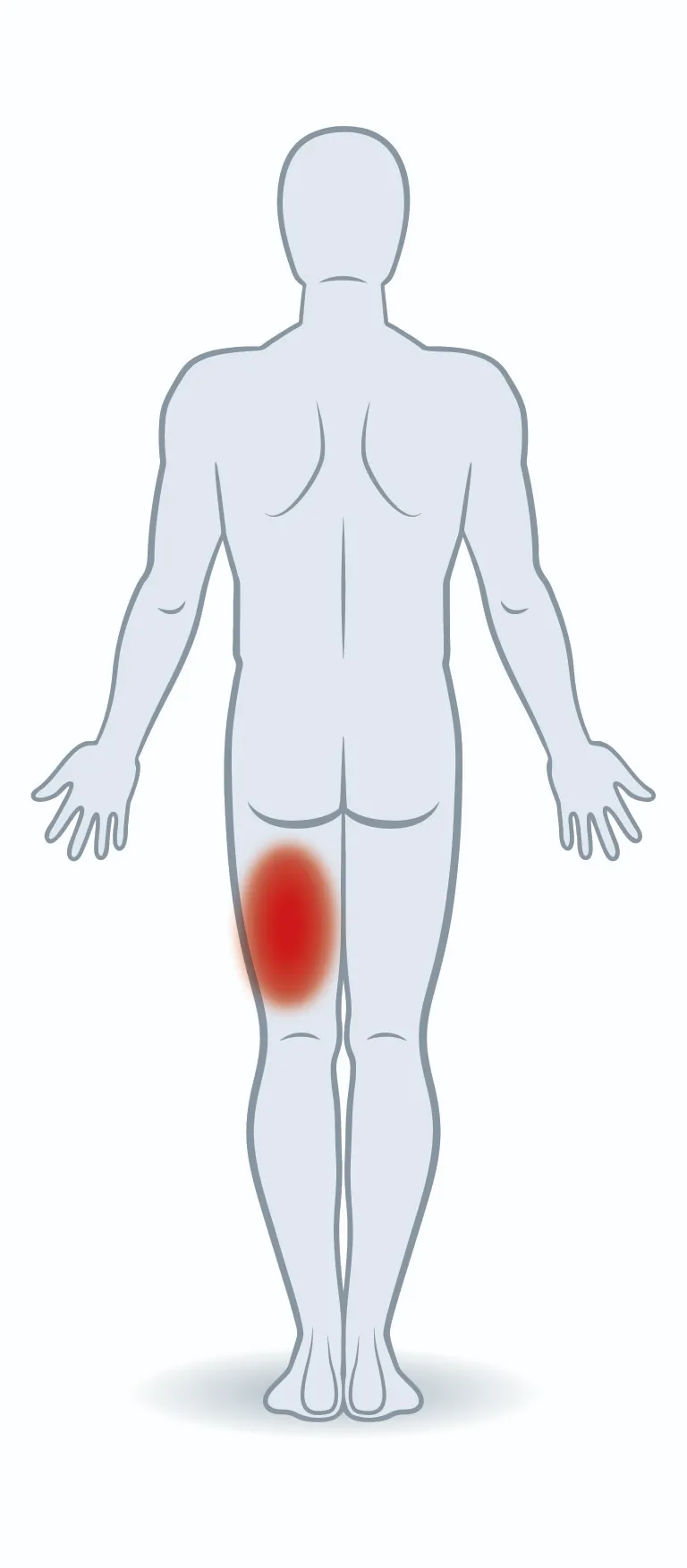 Schmerzpunkt Hamstring