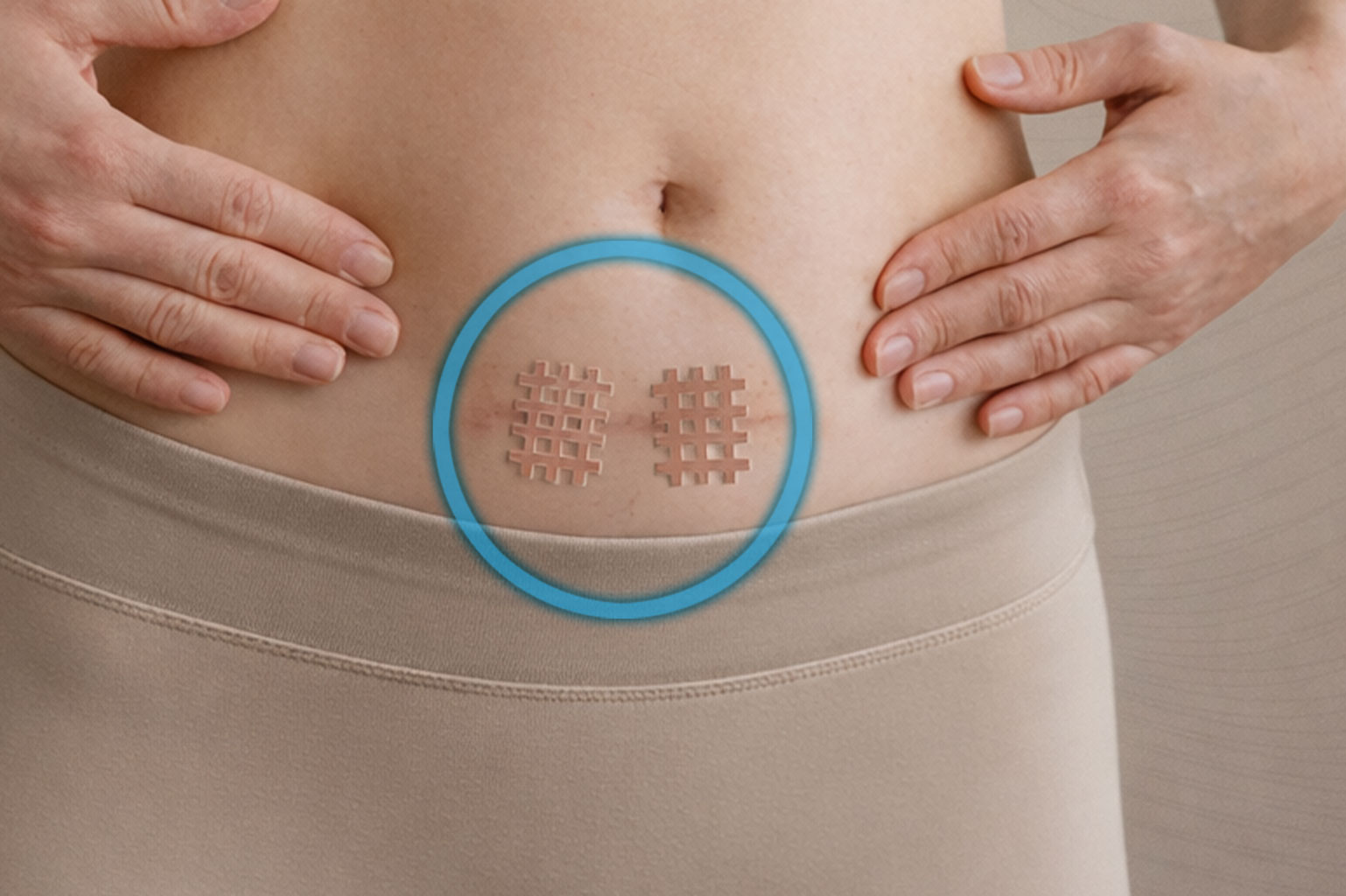 K-Active Crossing Anwendung auf Narben