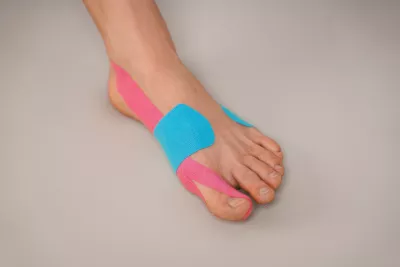 Hallux valgus Hallux valgus